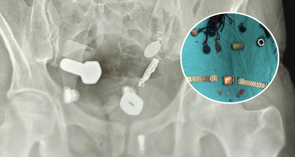 Muž si stěžoval na bolesti břicha – lékaři zůstali v šoku, když zjistili, co měl uvnitř!