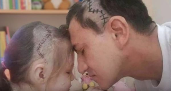 Otec si oholil hlavu, aby vypadal jako jeho nemocná dcera. Nádherné gesto!